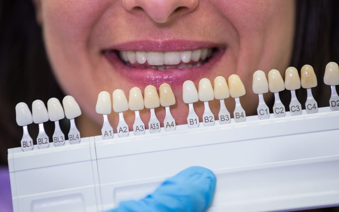A tooth shade guide held in front of a smile to match filling colour